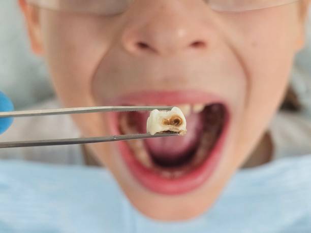 Best Emergency Dental Filling Replacement  in Raton, NM